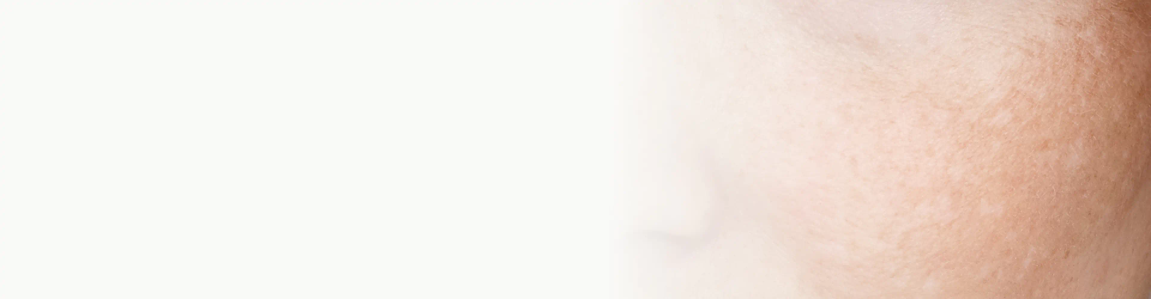 Detailed view of a cheek with visible redness and texture