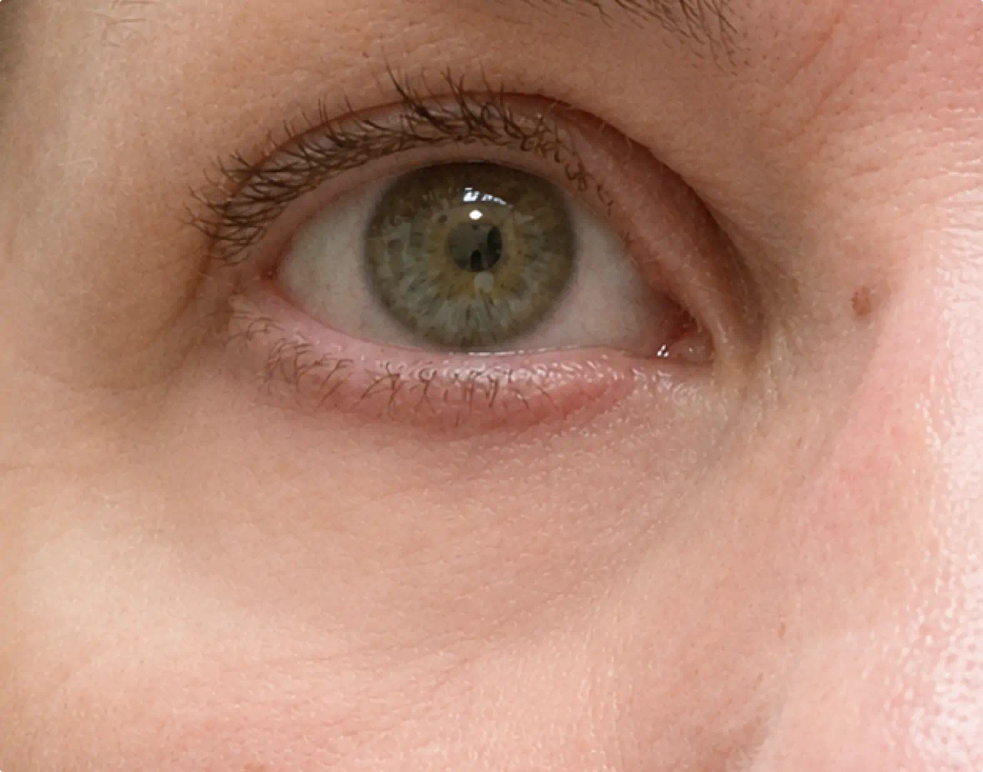 Under-eye area with the bundle looking brighter and firmer