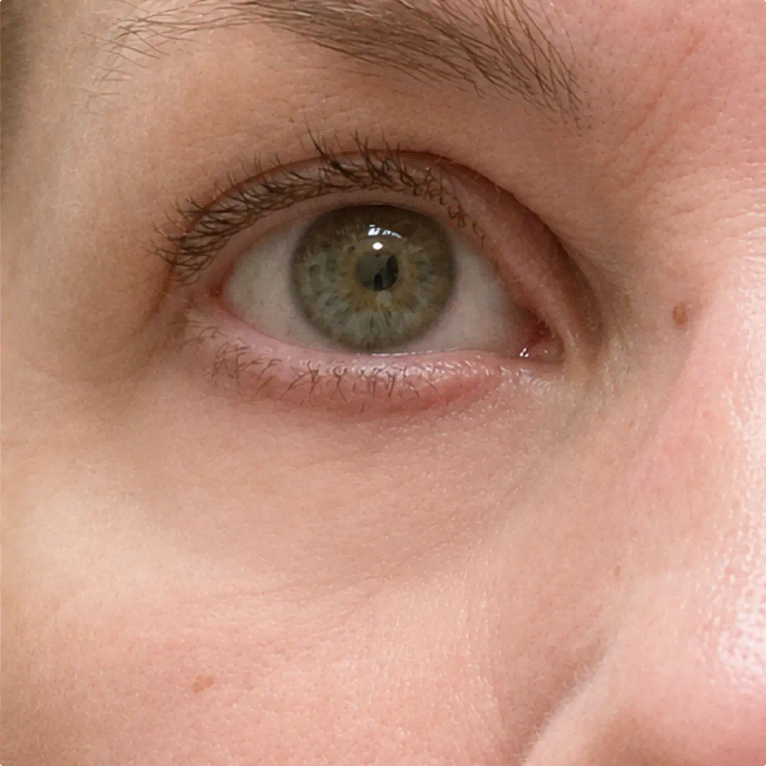 Under-eye area with the bundle looking brighter and firmer