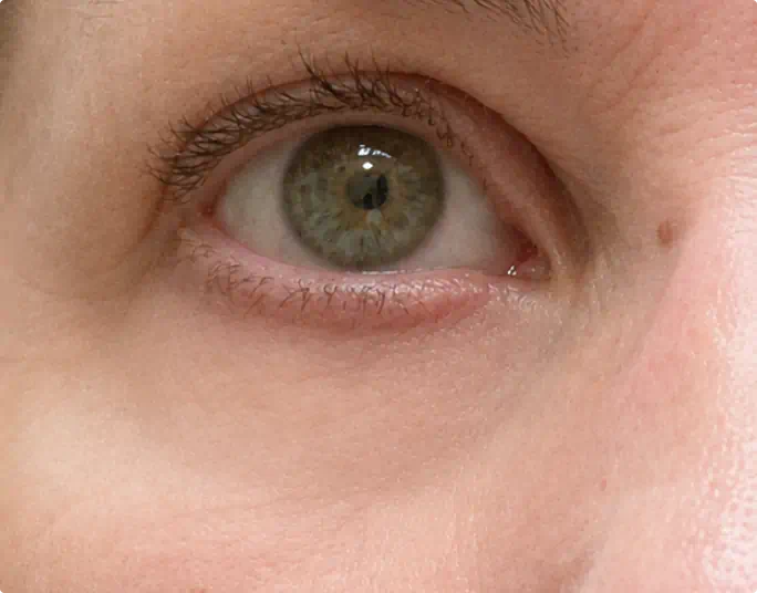 Under-eye area with the bundle looking brighter and firmer