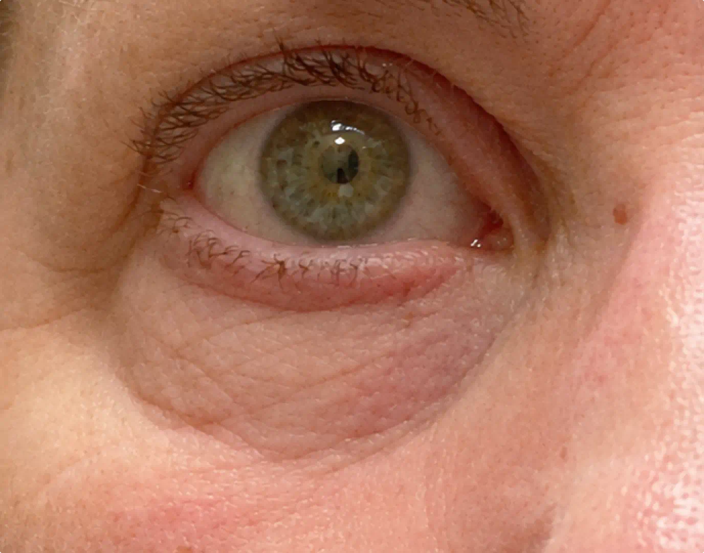 Under-eye area without the bundle showing puffiness and dark shadows