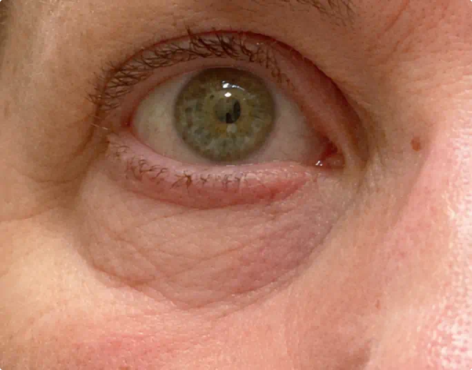 Under-eye area without the bundle showing puffiness and dark shadows